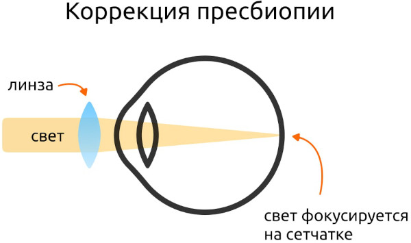 Пресбиопия глаз. Что это такое у взрослых, как лечить