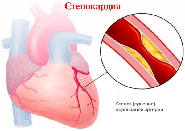 Сетегис (Setegis). Инструкция по применению, цена, отзывы