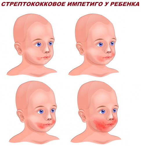 Стрептодермия. Что это такое, заразно или нет