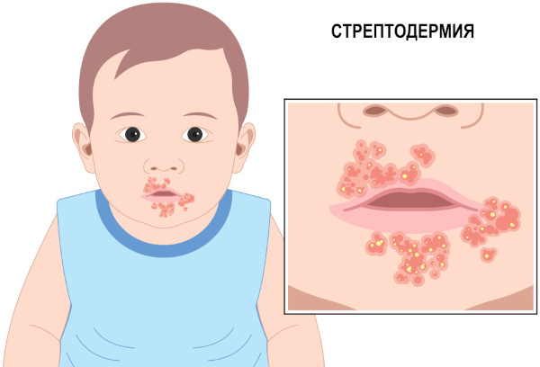 Стрептодермия. Что это такое, заразно или нет