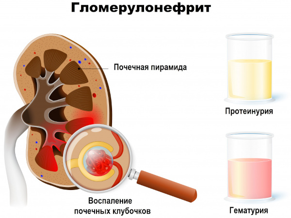 Стрептодермия. Что это такое, заразно или нет