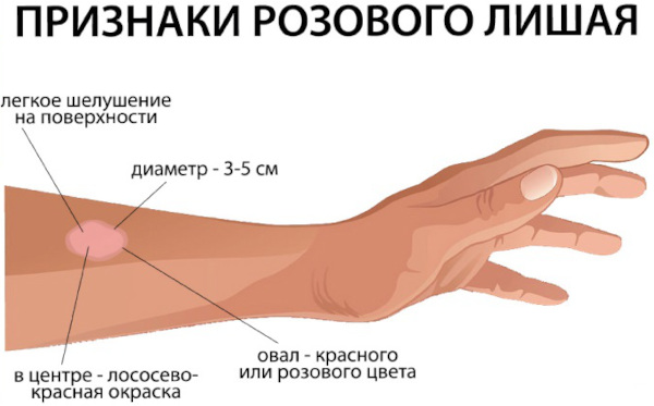 Стрептодермия. Что это такое, заразно или нет