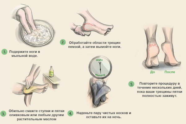 Трещины на пятках. Лечение в домашних условиях быстро и эффективно