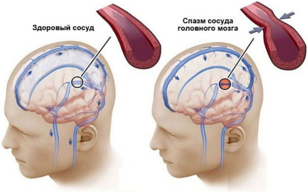 Вертигохель (Vertigoheel). Инструкция по применению, цена, отзывы