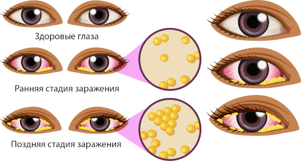 Визаллергол (Vizallergol) глазные капли. Инструкция по применению, цена