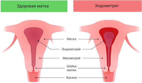 Замершая беременность. Признаки в первом триместре, симптомы, причины