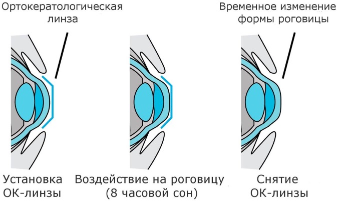 Подбор контактных линз. Как правильно выбрать лучшие