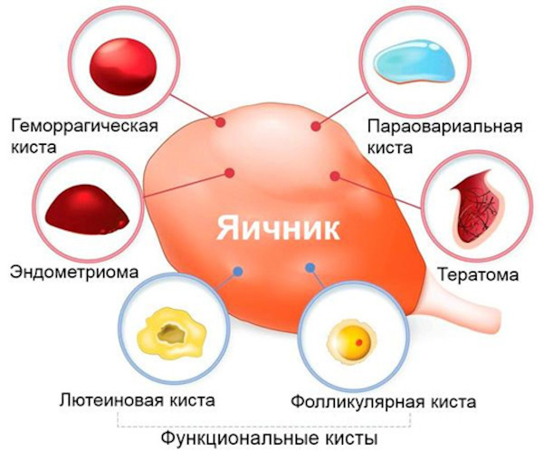 Киста яичника. Симптомы, признаки справа у женщин