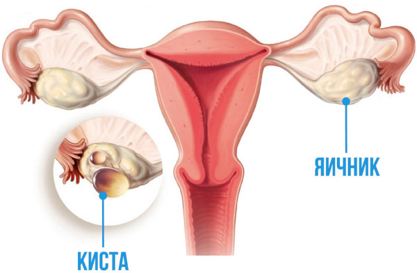 Киста яичника. Симптомы, признаки справа у женщин