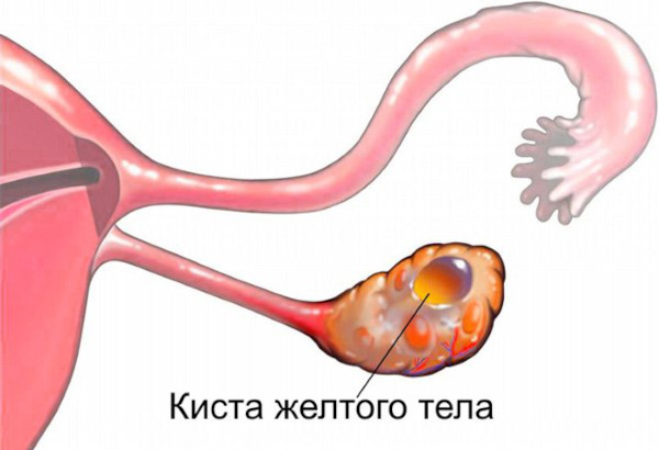 Киста яичника. Симптомы, признаки справа у женщин