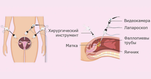 Киста яичника. Симптомы, признаки справа у женщин