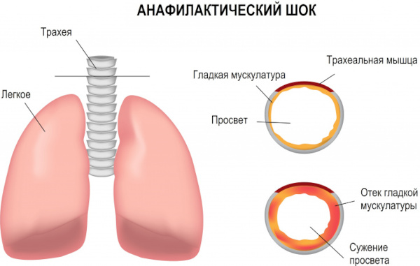 Первая помощь при шоке. Алгоритм действий