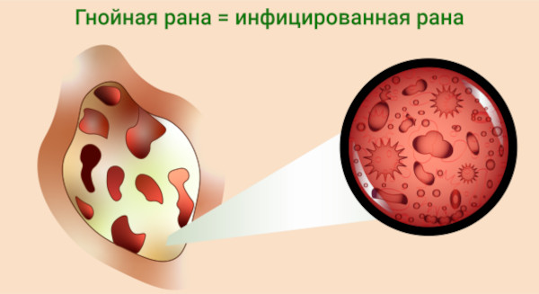 Антибиотики при гнойных ранах у взрослых в таблетках. Список