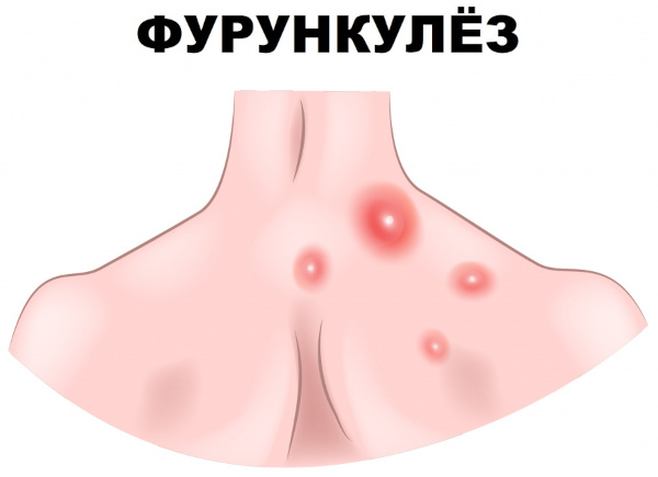 Антибиотики при гнойных ранах у взрослых в таблетках. Список