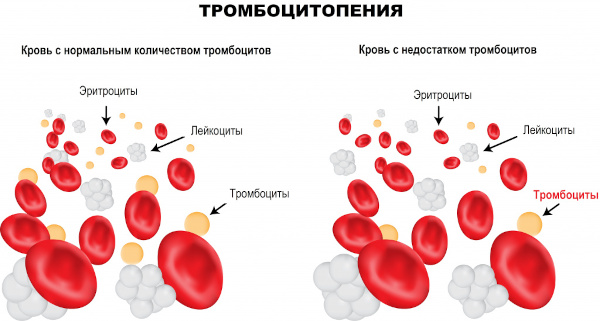 Аутоиммунная тромбоцитопения. Что это такое, лечение