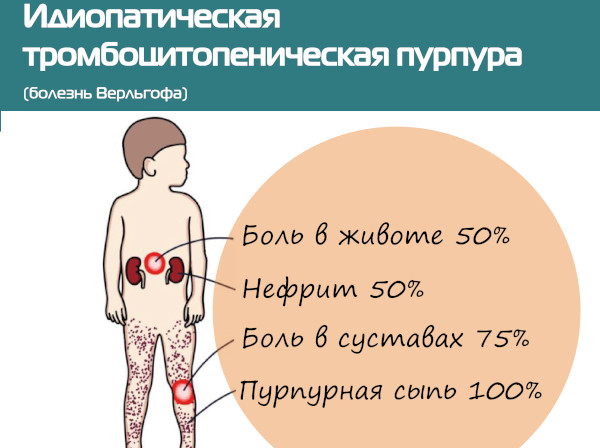 Аутоиммунная тромбоцитопения. Что это такое, лечение