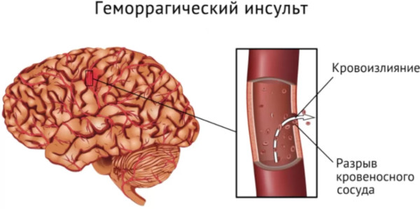 Аутоиммунная тромбоцитопения. Что это такое, лечение