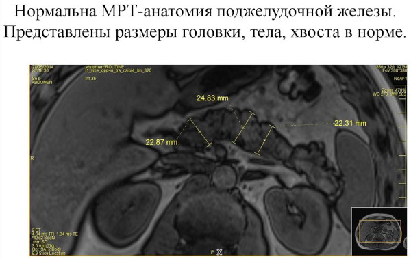 Аутоиммунный панкреатит. Симптомы, клинические рекомендации