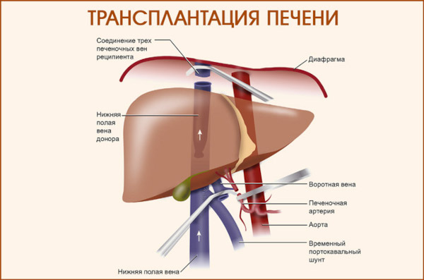 Билиарный цирроз печени. Что это такое, симптомы, лечение