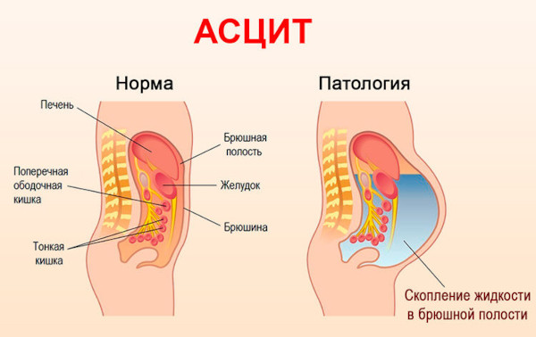 Билиарный цирроз печени. Что это такое, симптомы, лечение