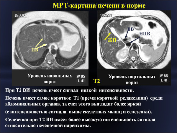 Билиарный цирроз печени. Что это такое, симптомы, лечение