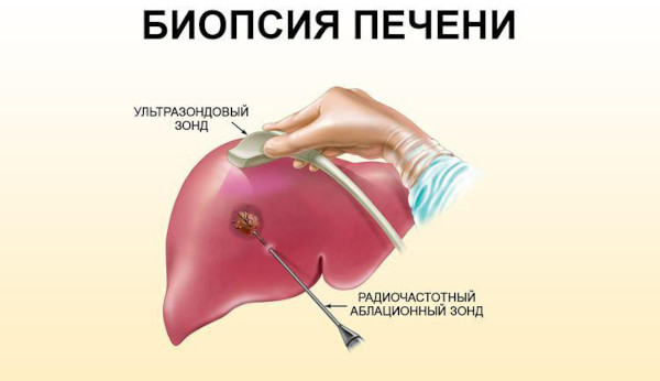 Билиарный цирроз печени. Что это такое, симптомы, лечение