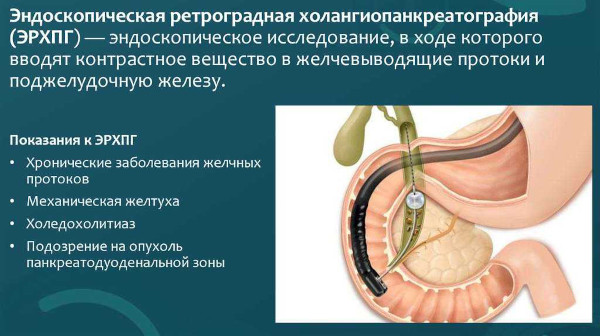 Билиарный цирроз печени. Что это такое, симптомы, лечение