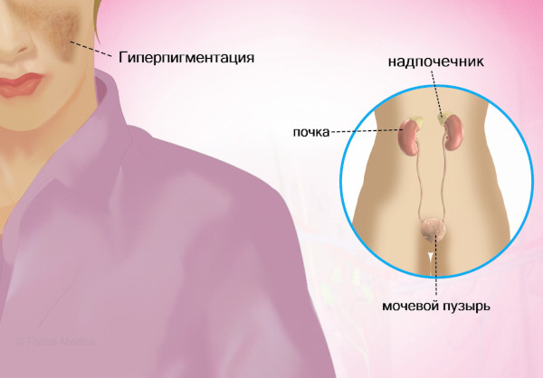 Болезнь Аддисона (бронзовая). Что это такое, симптомы