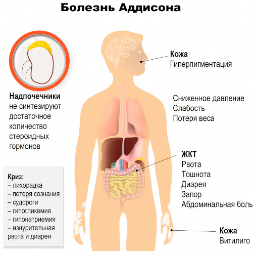 Болезнь Аддисона (бронзовая). Что это такое, симптомы