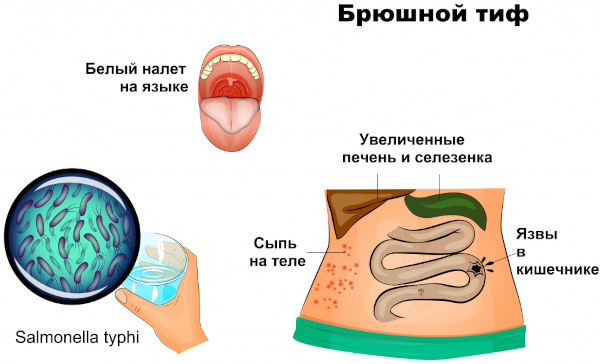 Брюшной тиф. Симптомы у детей, лечение