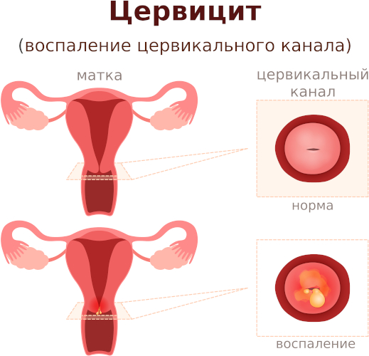 Enterococcus Faecalis (фекальный энтерококк) в мазке у женщин