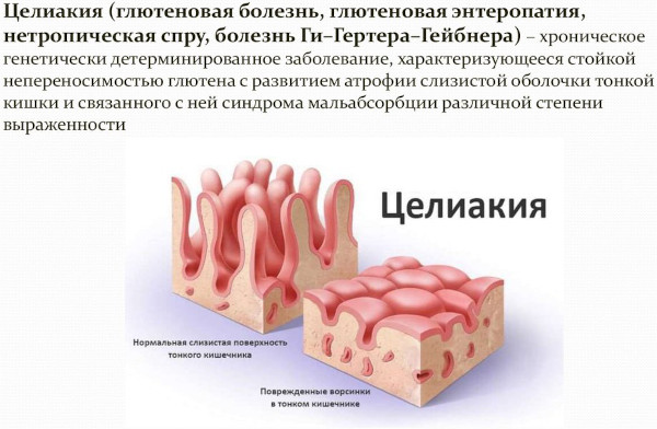 Глютеновая энтеропатия. Клинические рекомендации