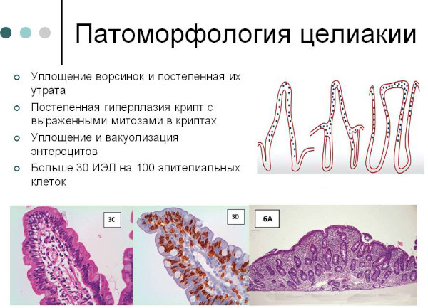 Глютеновая энтеропатия. Клинические рекомендации