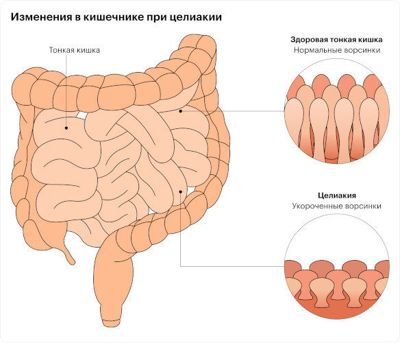 Глютеновая энтеропатия. Клинические рекомендации