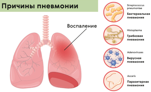 Карбапенемы препараты антибиотики. Что это, список