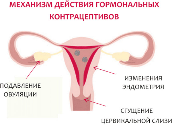 Киста яичника. Можно ли лечить без операции