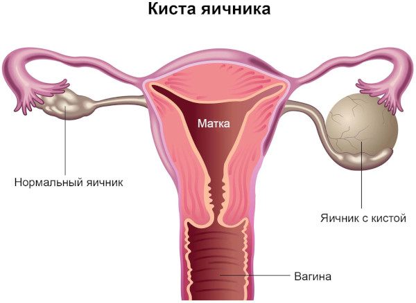 Киста яичника. Можно ли лечить без операции