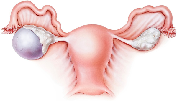Киста яичника. Можно ли лечить без операции
