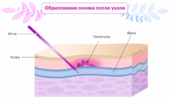 Мазь от синяков на лице после уколов быстродействующая