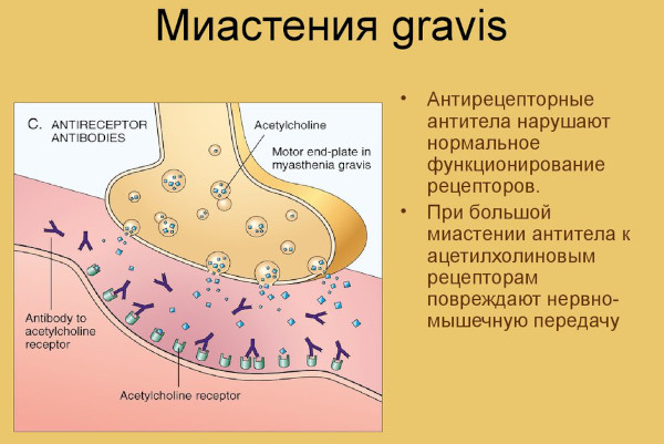 Миастения гравис (бульбарный паралич). Что это такое