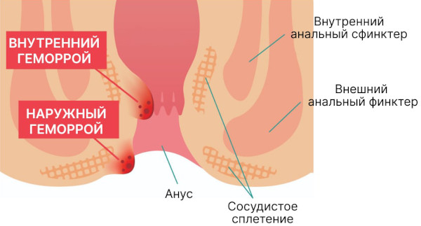 Народные средства от геморроя у мужчин. Эффективные рецепты