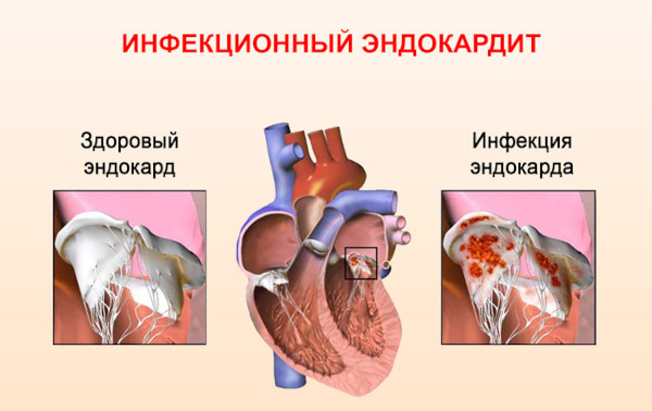 Орнитоз это что за болезнь. Симптомы, лечение