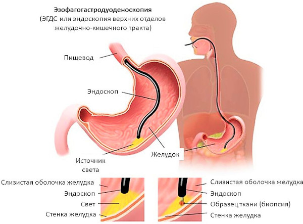 Пернициозная анемия. Что это значит