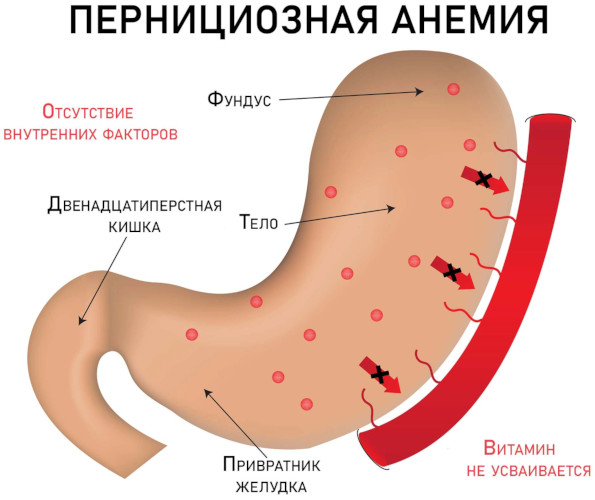 Пернициозная анемия. Что это значит