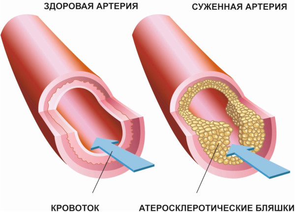 Пернициозная анемия. Что это значит