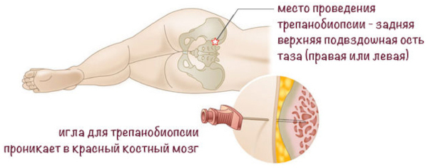 Пернициозная анемия. Что это значит