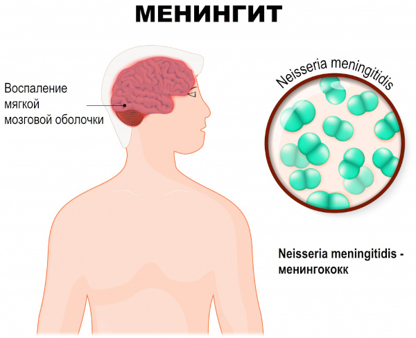 Профилактика менингита у взрослых при контакте с больным