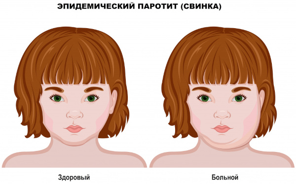 Профилактика менингита у взрослых при контакте с больным