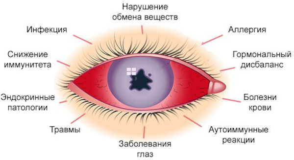 Симпатическая офтальмия. Что это такое, клинические рекомендации