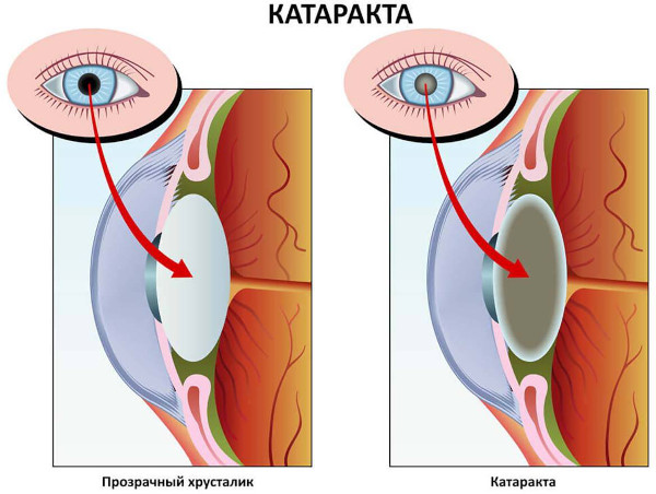 Симпатическая офтальмия. Что это такое, клинические рекомендации